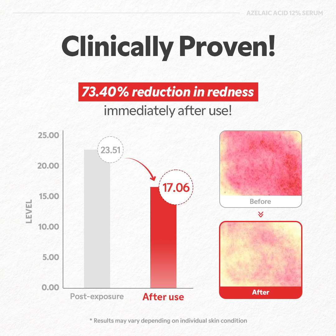 Azelaic Acid 12% Serum - Lightweight Dark Spot Reducer, Gentle Breakout care, For Uneven skin tone, Redness, Red Marks and Acne