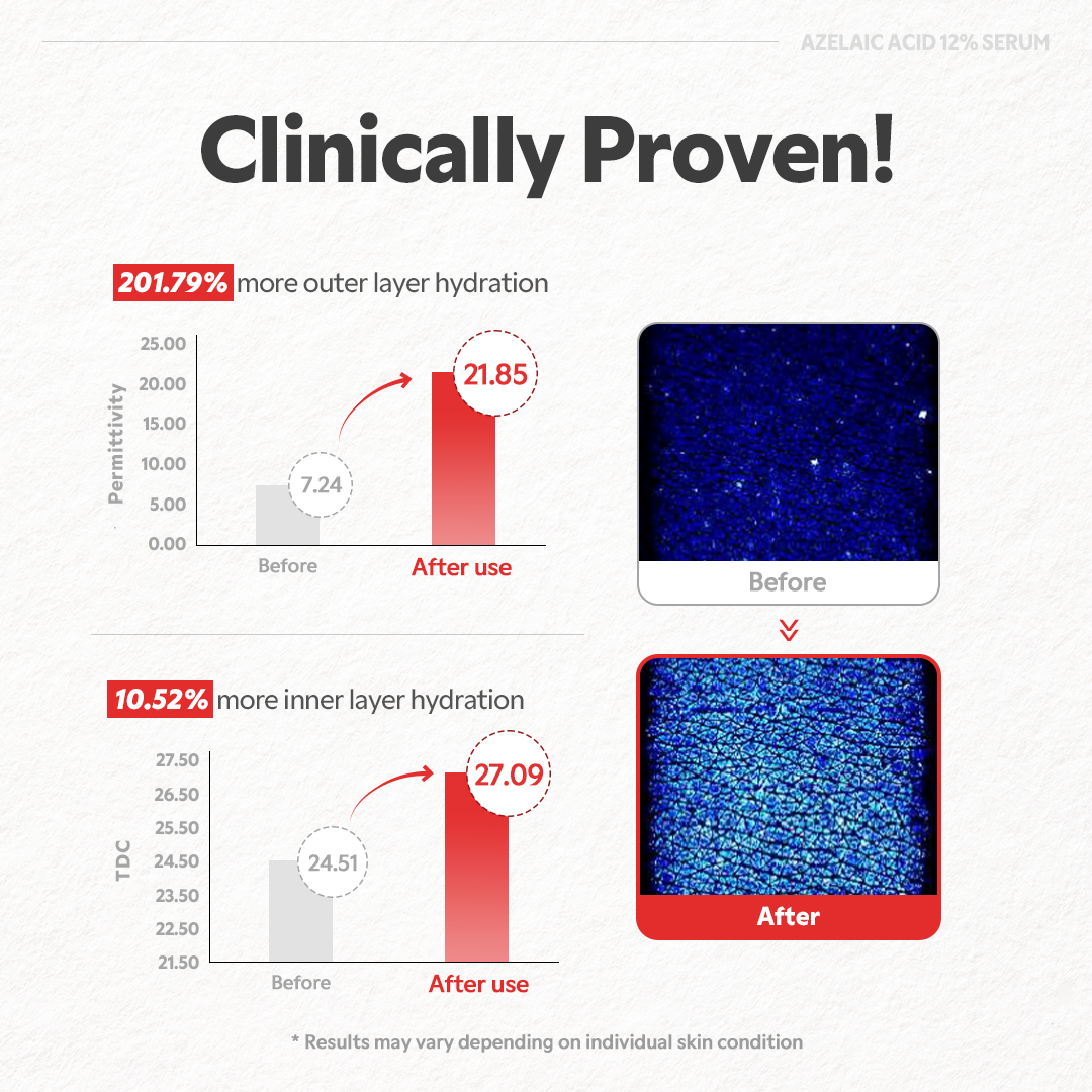 Azelaic Acid 12% Serum - Lightweight Dark Spot Reducer, Gentle Breakout care, For Uneven skin tone, Redness, Red Marks and Acne